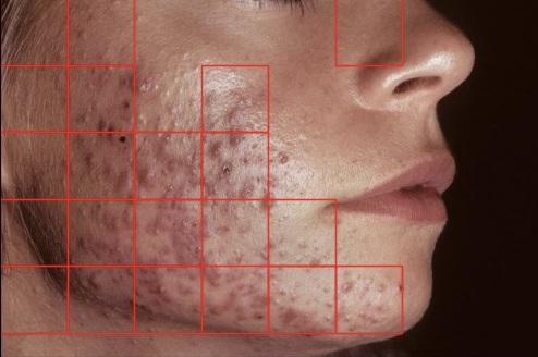 Acne Detection & Severity Classification App overview